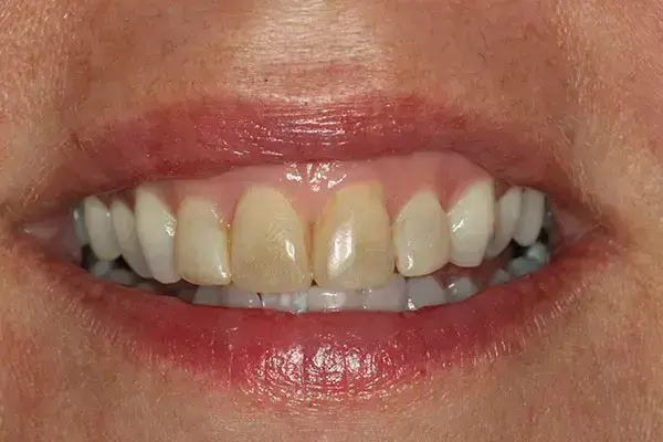 Porcelain Veneers antes