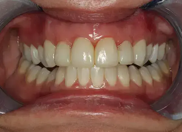 Muestra de transformación de sonrisa con IA