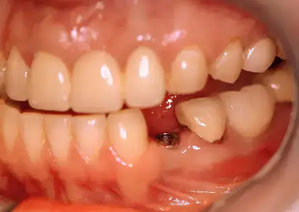 Permanent Porcelain Crowns antes