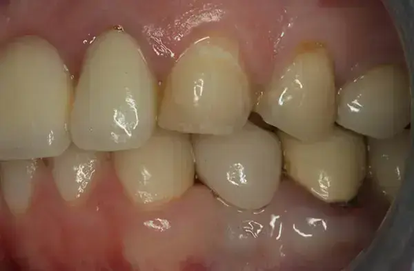Permanent Porcelain Crowns después