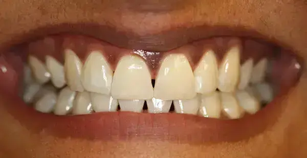 Zoom In-Office Teeth Whitening después