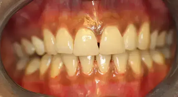 Zoom In-Office Teeth Whitening antes